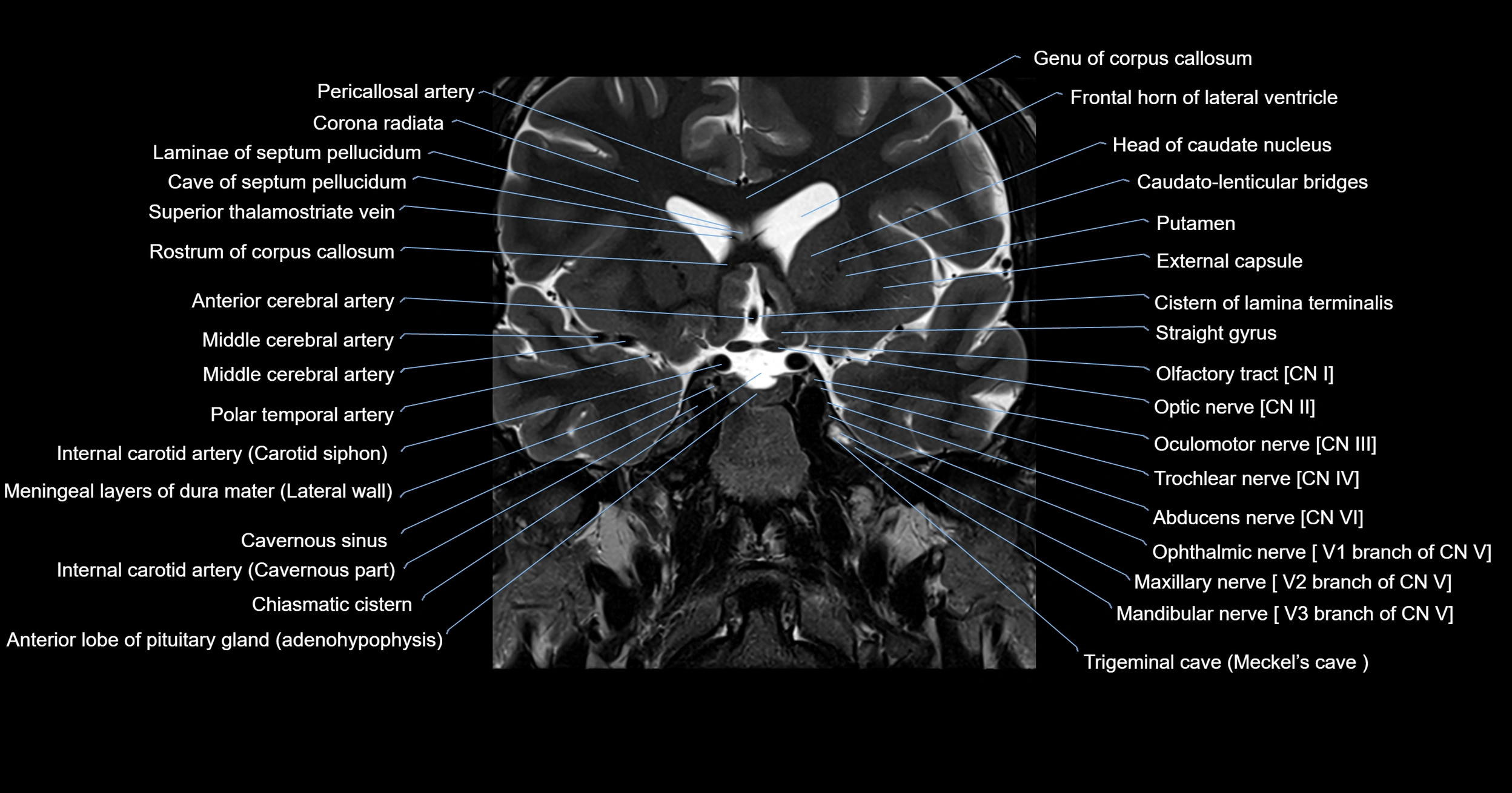 MRI brainstem & basal ganglia anatomy labelled 3T MRI images -img-00001-00010.webp